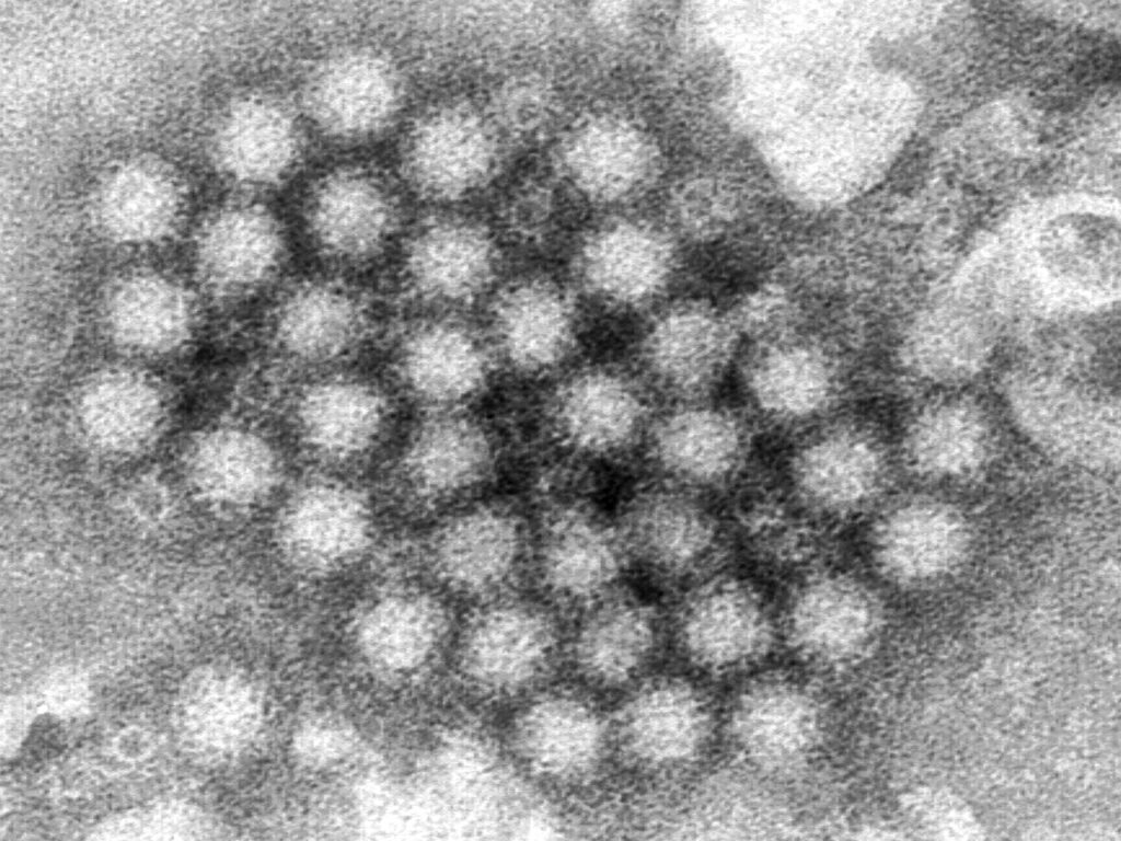 Norovirus is spiking in the US: What do we need to know? | Health News