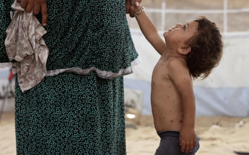 Chickenpox emerges as growing public health threat in Gaza