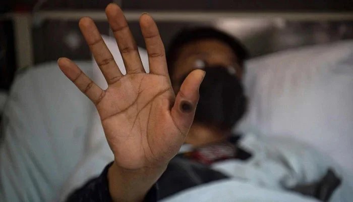 Sindh reports another mpox case, provincial tally reaches 41
