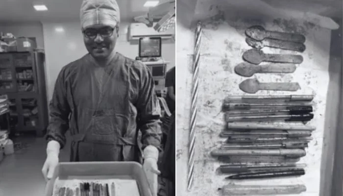 Doctors remove 14 pens, spoons, candle from woman’s stomach in India